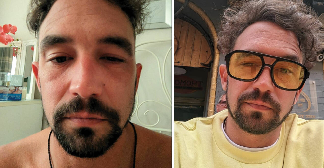 Luke, 33, får mystisk huvudvärk – samma tid varje dag: ”Ren tortyr”
