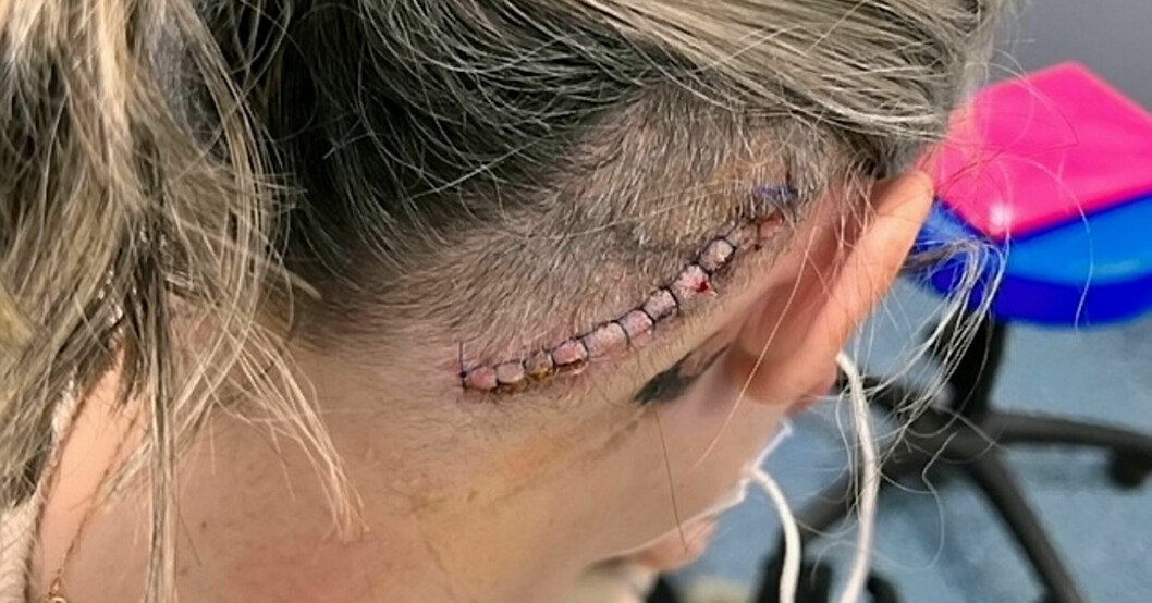 Tumören som satt i närheten av Sues högra öra har orsakat dövheten på samma öra. Det påverkar även hennes smak och den blockerar tårkanalen.