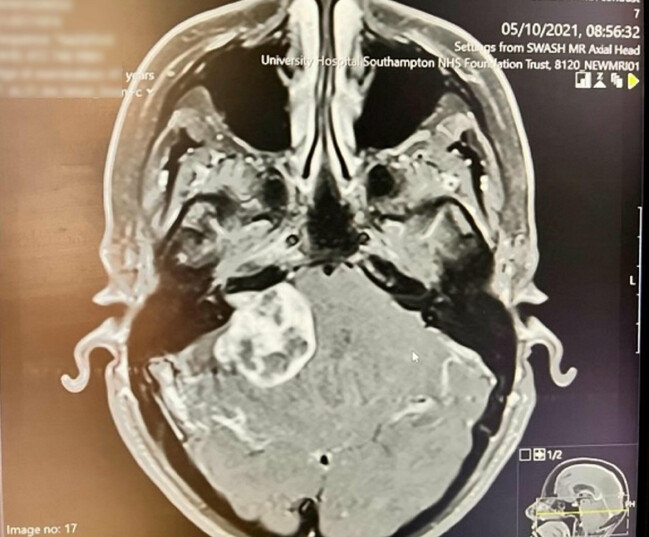 Magnetröntgenbild på Sues skalle.