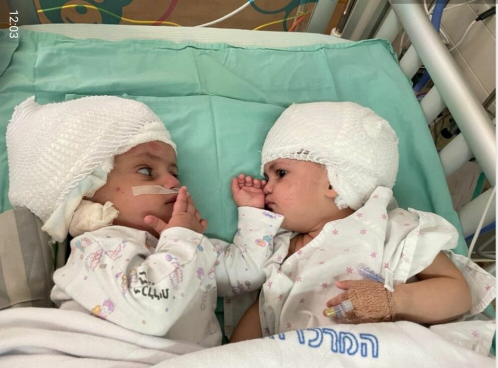 <strong>För första gången någonsin kan tvillingflickorna äntligen se på varandra. Flickornas familj har valt att inte lämna ut deras namn.</strong> För första gången någonsin kan tvillingflickorna se varandra.
