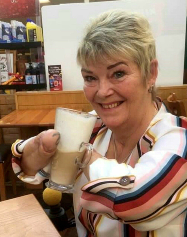 Kim kan inte göra mycket själv utan sina händer. Efter sin handtransplantation hoppas hon kunna bli mer självständig. Kim dricker kaffe utan händer.