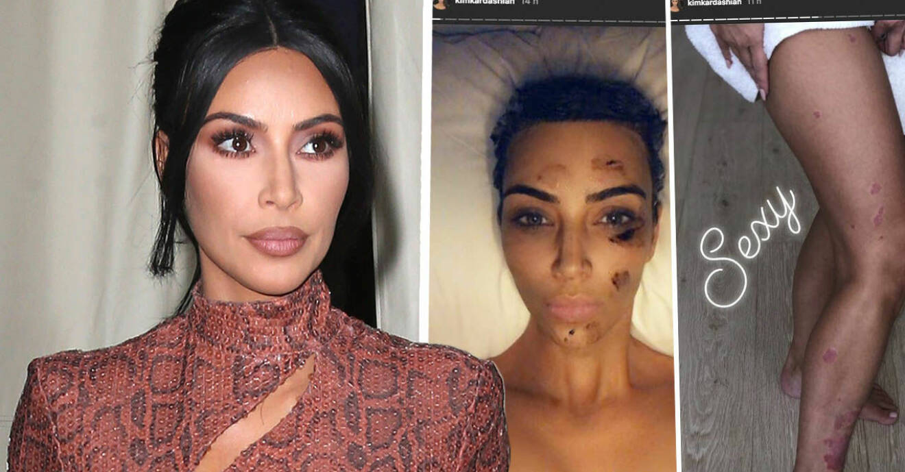 Kim Kardashian visar upp sina psoriasis-utslag.