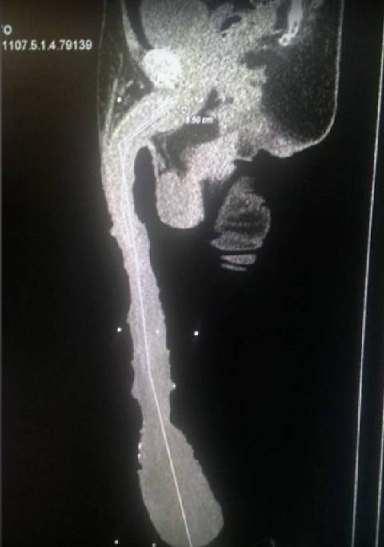 Roberto röntgenbild på penisen