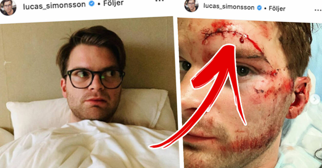 Lucas simonssons skräckskada efter sparkcykeln