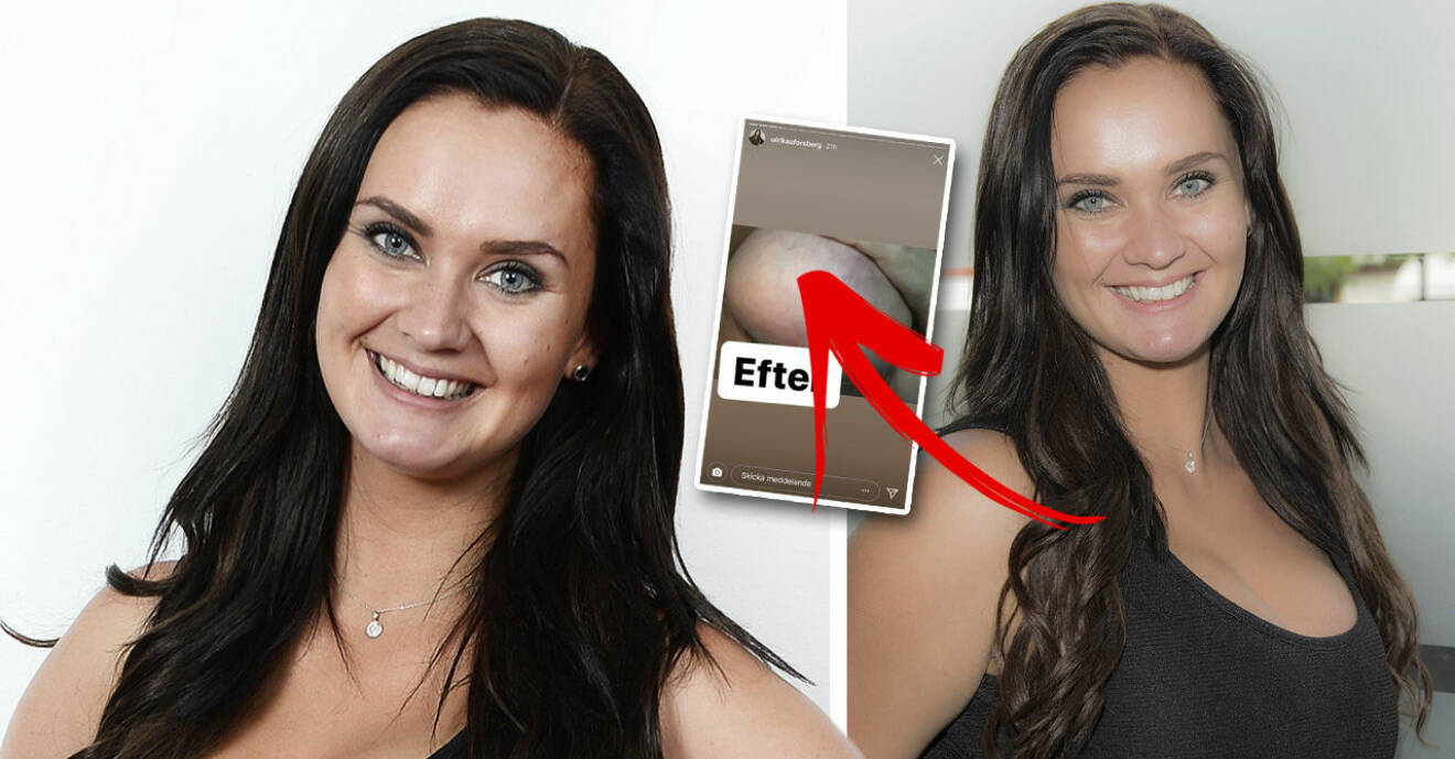 Paradise hotel-profilen Ulrika Forsberg visar upp bilder på sina ärr efter nya bröstoperationen.