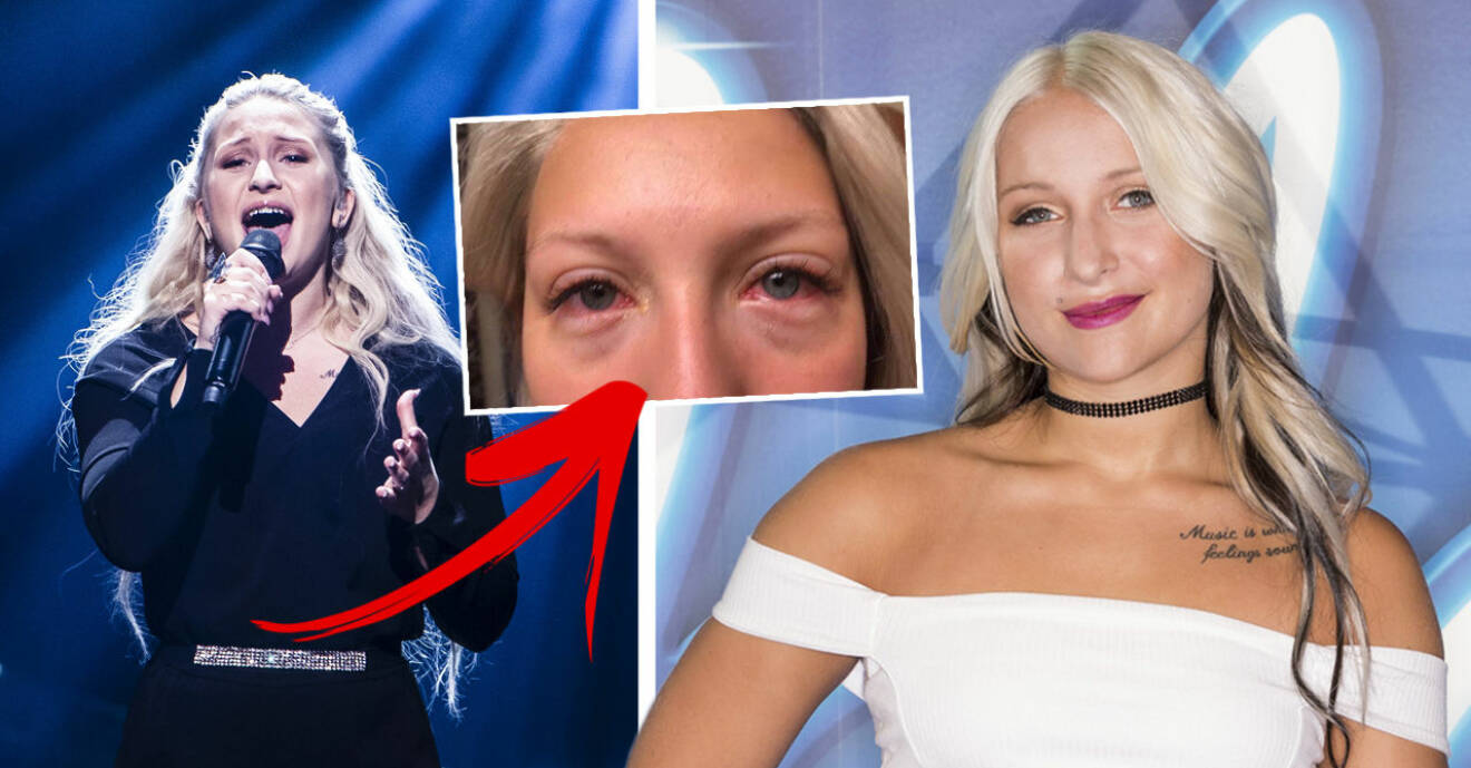 Rebecka Karlsson om misslyckade skönhetsbehandlingen som förstörde hennes ögon.