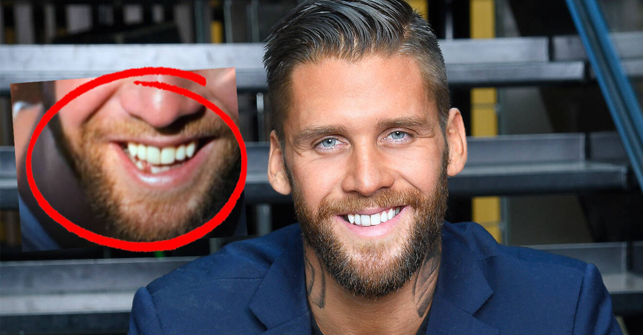 Sanningen bakom Simon Hermanssons skadade tand i Bachelor