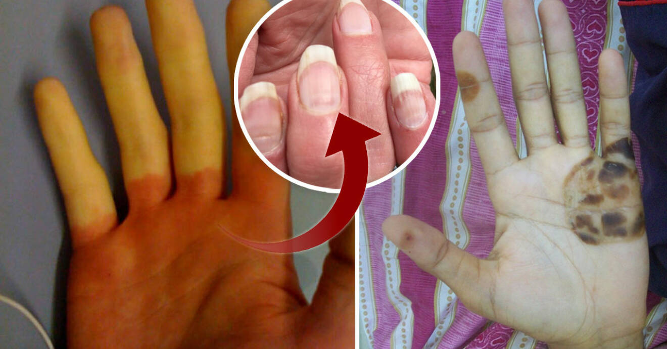 Symptom på dina händer och fingrar kan visa om du är sjuk.
