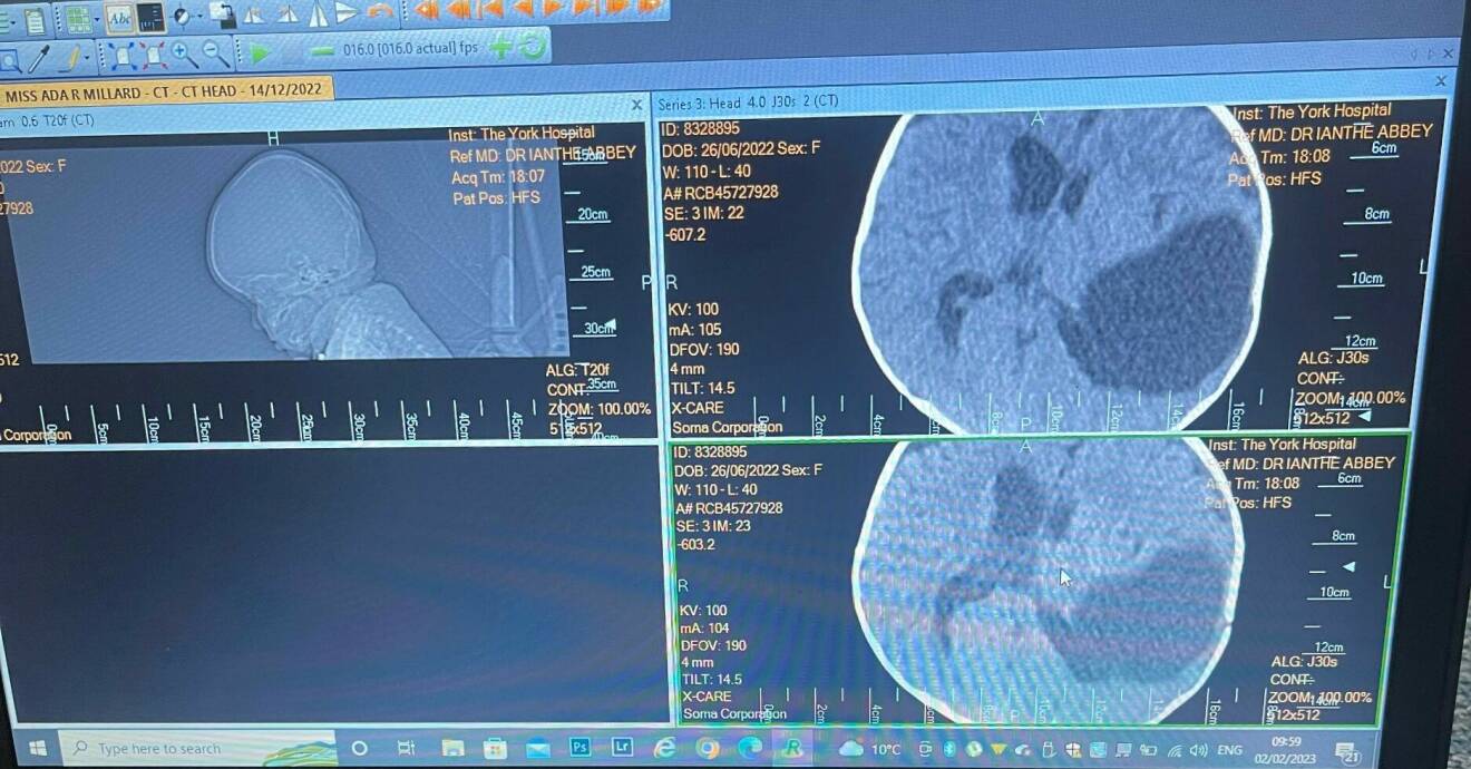 Röntgenbilder på cystan som växer i Adas huvud. Man ser att den lagt sig på ena sidan och den har pressat resten av hjärnan åt andra hållet.