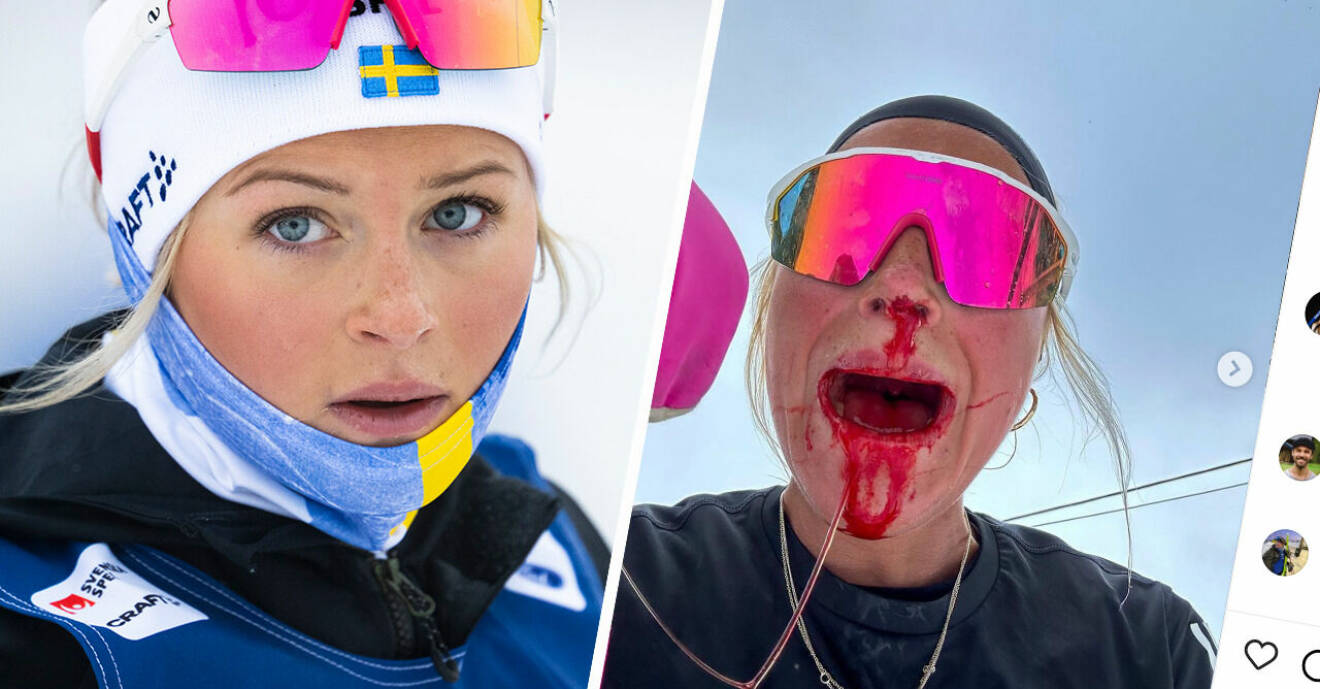 Frida Karlsson visar upp sitt blodiga ansikte – bara dagar efter lyxsemestern.