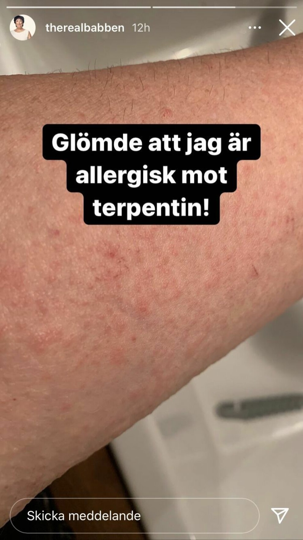 Bilden visar allergiska reaktionen Babben Larsson