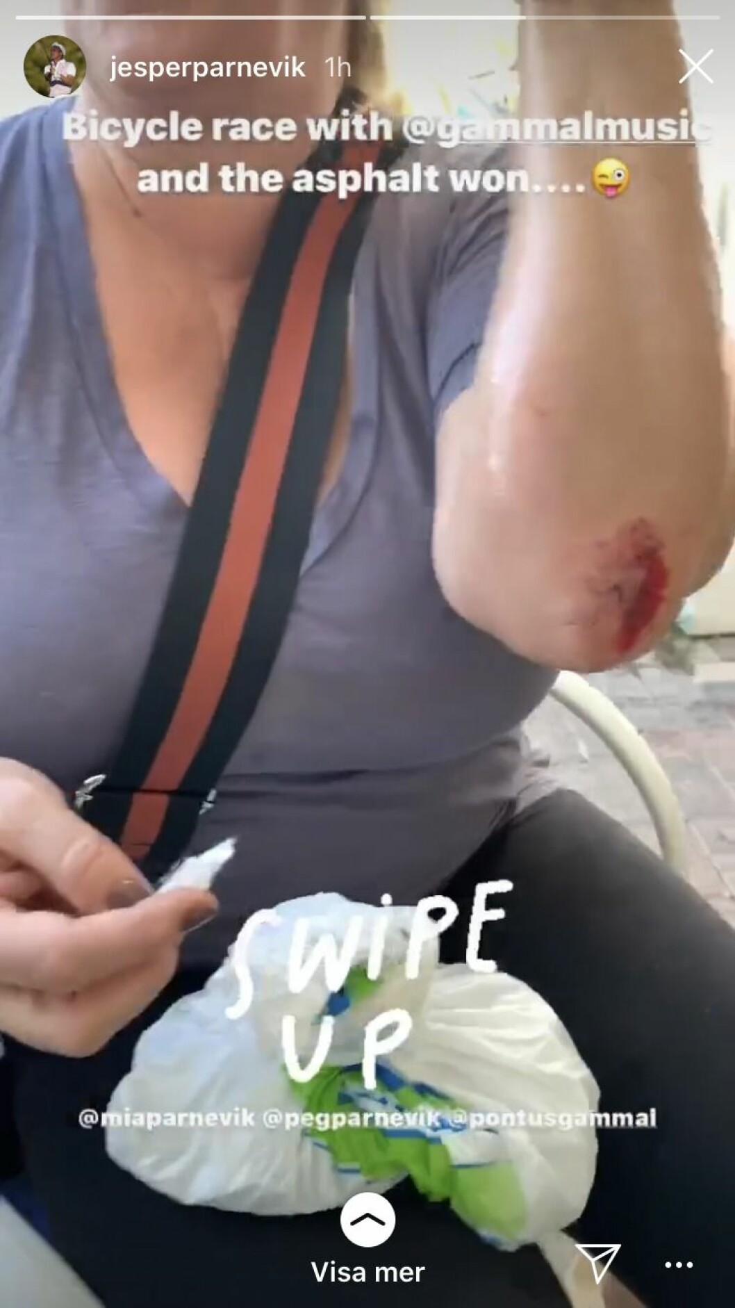 Mia Parnevik visar upp sina skador. Mia Parnevik visar upp sina skador.