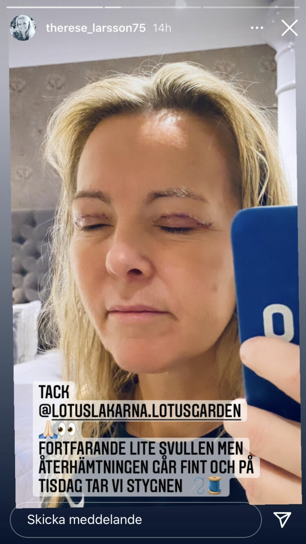 Therese Larsson har opererat ögonlocken.