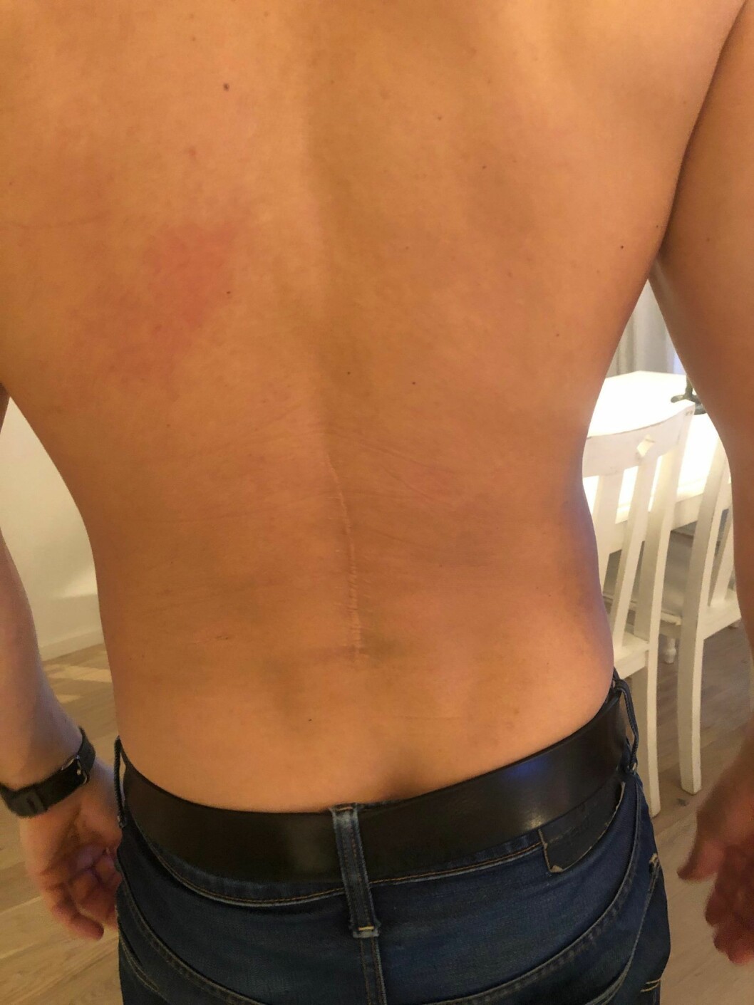 Ärret efter kompartment-operationen Robban gjorde i ryggen då han var 20. Robinson-Robbans ärr efter operationen.