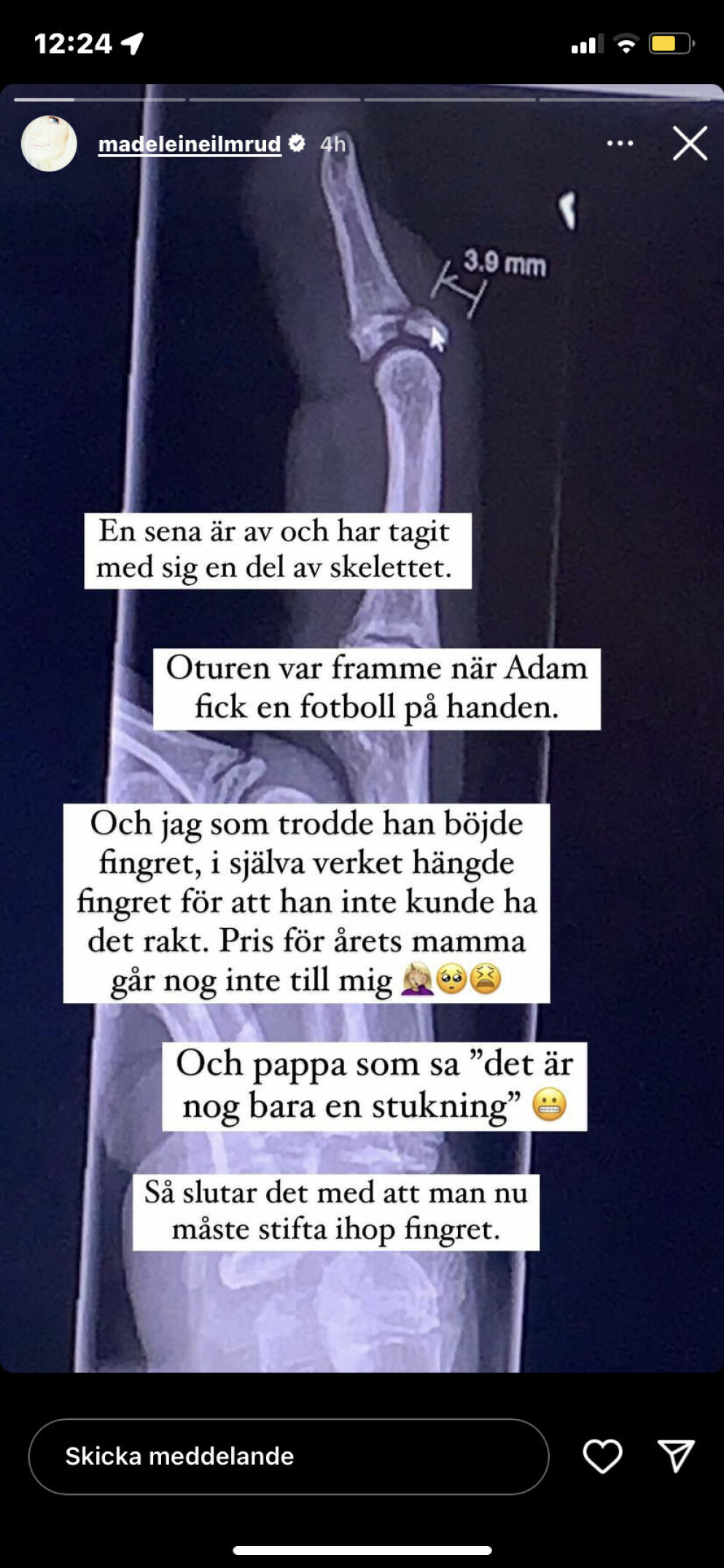 Röntgenbild på sonen Adams finger.