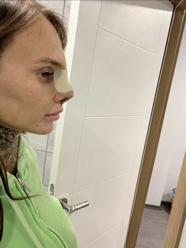 Efter operationen – privat bild