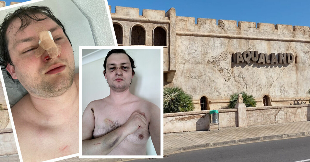 Läkarstudenten James bröt näsan i svenskparadiset Teneriffa – rasar mot vattenparken.