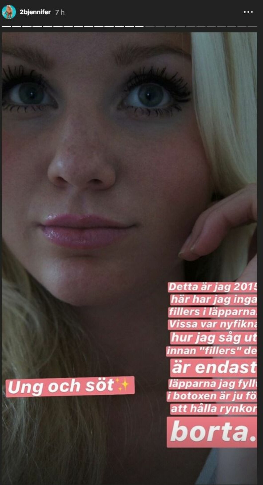 Så här såg Jennifer Karlsson ut innan hon gjorde fillers i läpparna. Jennifer Karlsson utan fillers I läpparna
