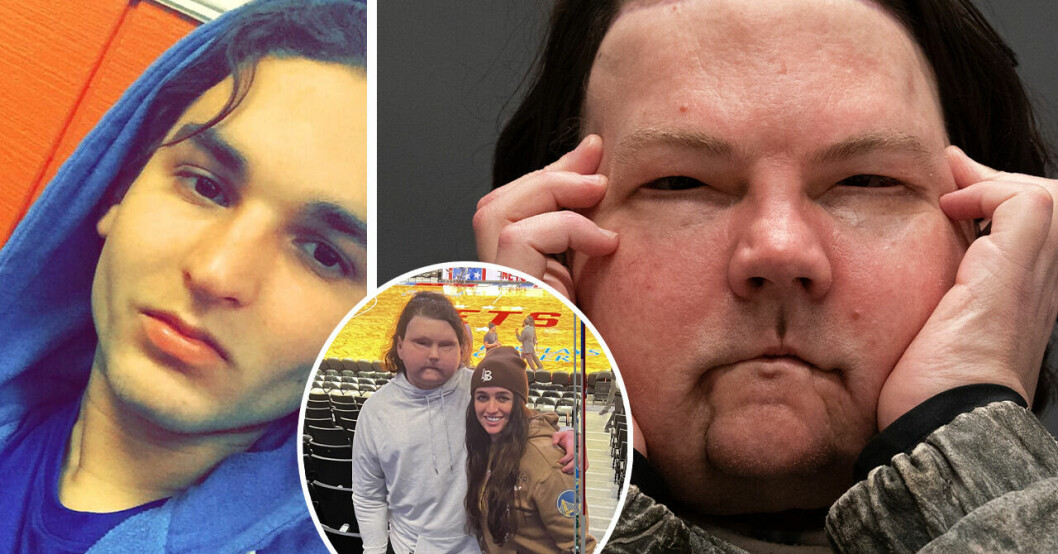 24-åring fick ett helt nytt ansikte efter olyckan – hittade kärleken.