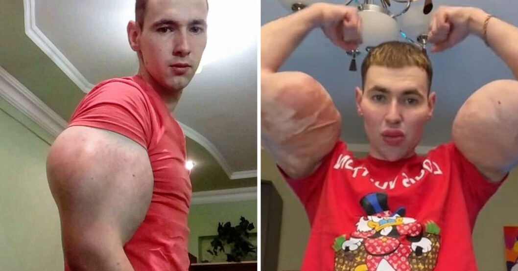 Kirill Tereshin injicerar sina muskler med olja – läkarna varna