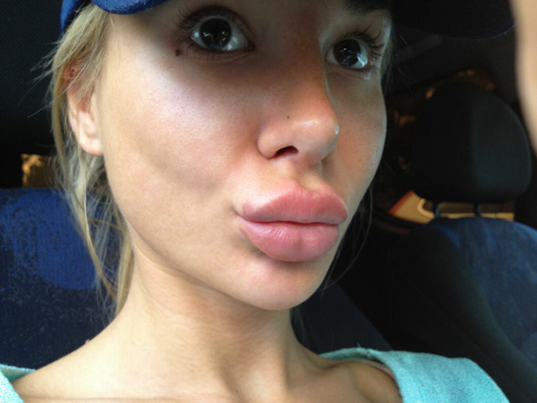 På bloggen visar Kissie upp sina uppsvällda läppar när det hände 2012. Via: <a href="http://www.kissies.se/">Kissies.se</a> kissie55
