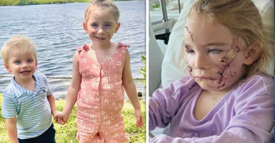 Pitbull attackerade 4-årig flicka.