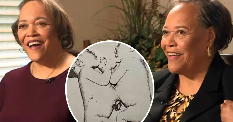 Siamesiska tvillingarna Lillian och Linda Matthews separerades efter fem veckor – så har deras liv blivit.