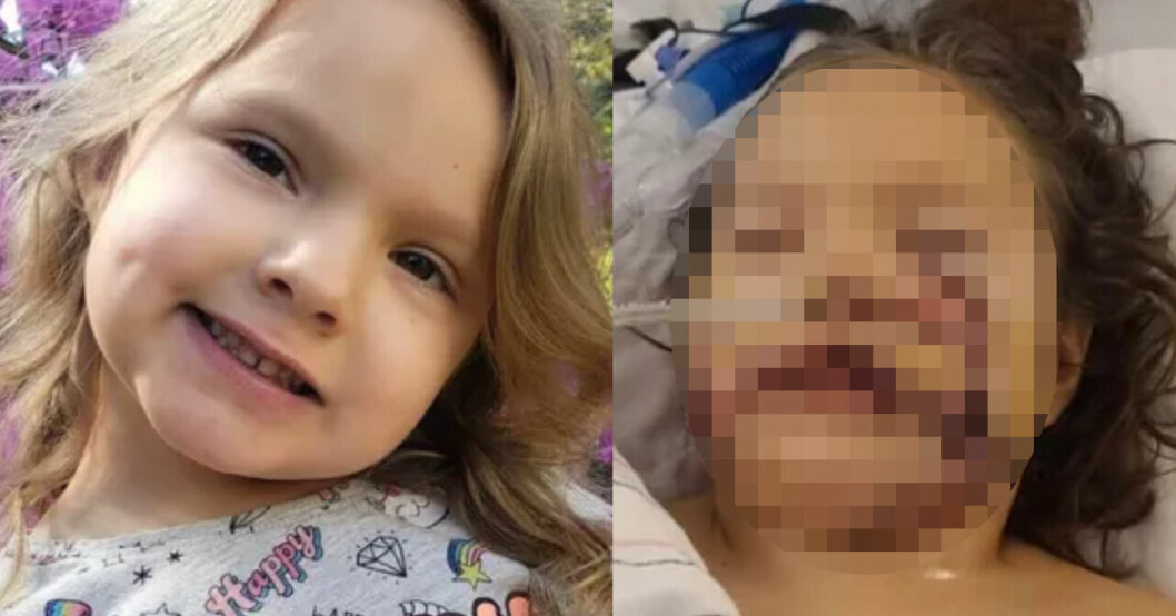 6-åriga Lily blev biten av en hund i ansiktet – fick sy över 1 000 stygn.