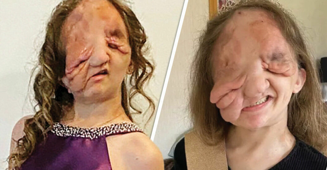 Lizzy har opererats över hundra gånger för tumörer i ansiktet.