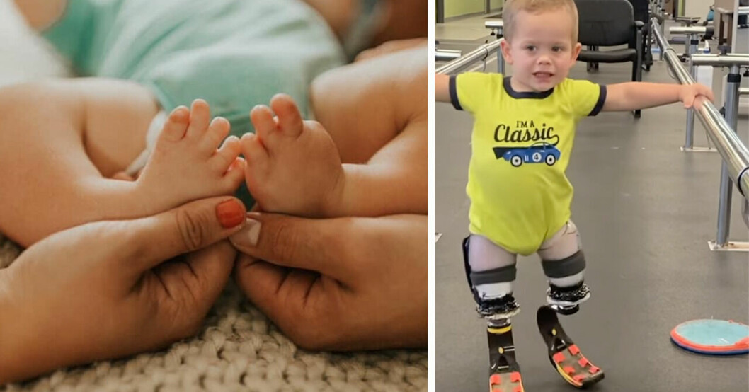 2-åriga Louie har lärt sig gå med sina proteser – tvingades amputera båda benen