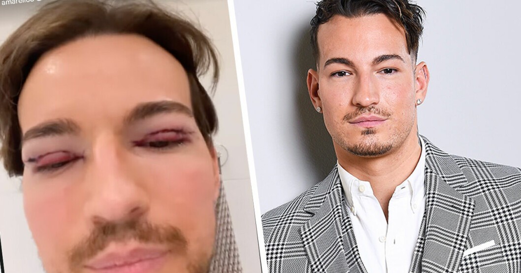 Marcelo Peñas utseendeförvandling efter skönhetsingreppet