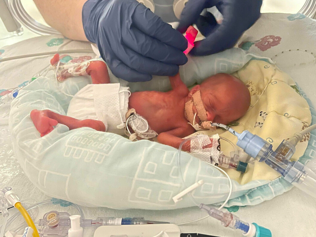 Hannah Stibbles föddes i vecka 25 – och vägde endast 311 gram.