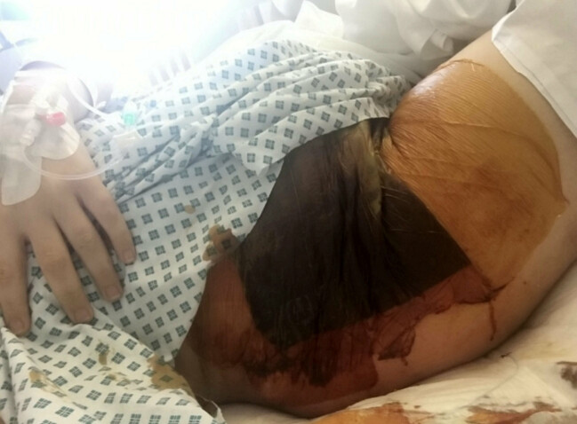 Amy fick en infektion orsakad av streptokocker. Amys sår.