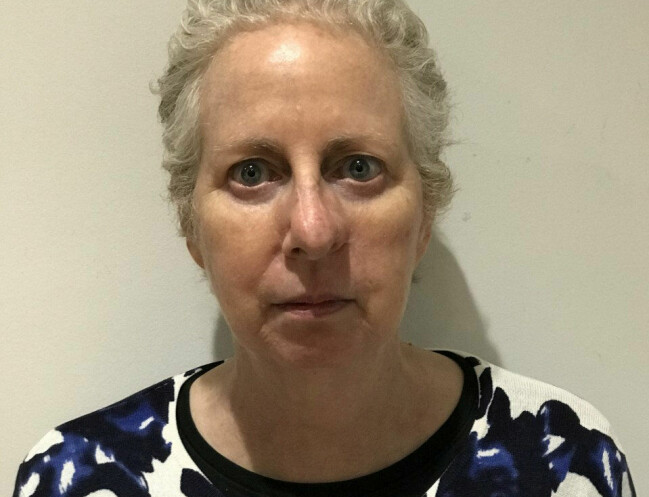 Elizabeth hade ingen aning om att hennes hudproblem var hudcancer. Elizabeth Williams innan operationen.