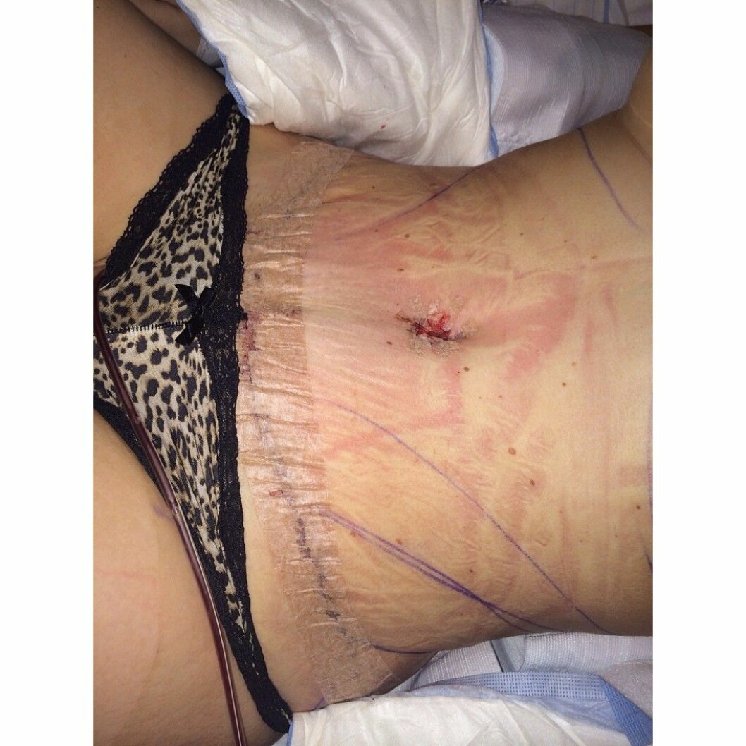 Efter bukplastikoperationen. Foto: My Martens <a href="http://blogg.alltforforaldrar.se/mammamy/">blogg</a> my-martens-operation