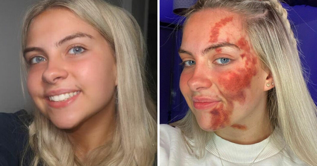 Nancy Morel lider av mystiska hudbesvär som emellanåt dyker upp