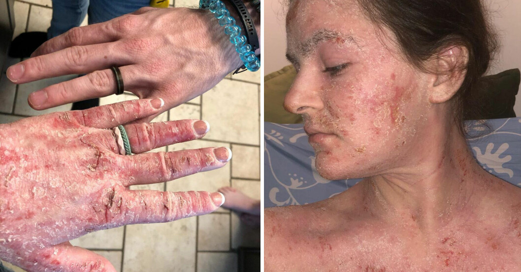 Natalie trodde hon hade eksem, men blev beroende av klådan.