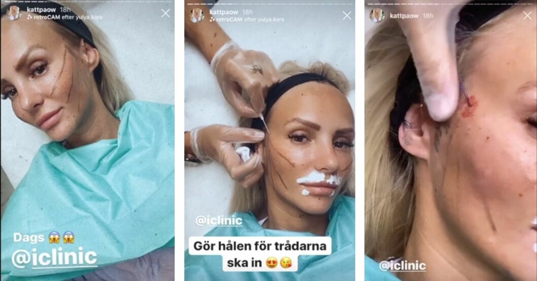 Paulina ”Paow” Danielsson visade upp ansiktslyftet på Instagram. Paulina ”Paow” Danielsson