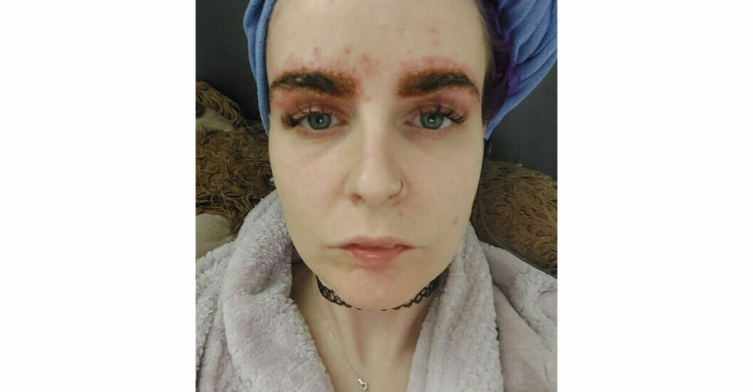 Clare McGuire vill nu uppmärksamma andra om riskerna. Clare drabbades av allergisk reaktion när hon färgade brynen.