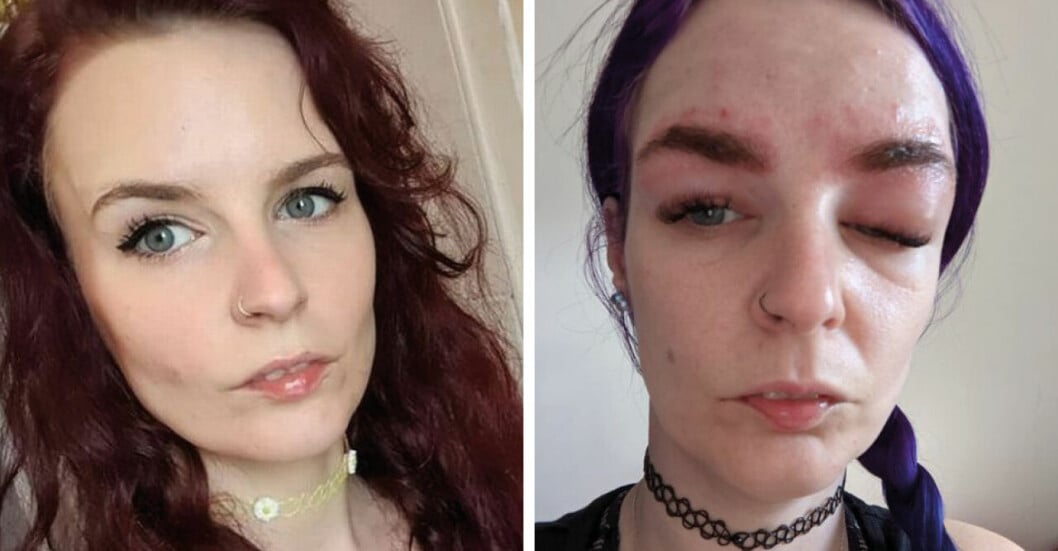 Clare McGuire, 34, fick allergisk reaktion när hon färgade ögonbrynen.