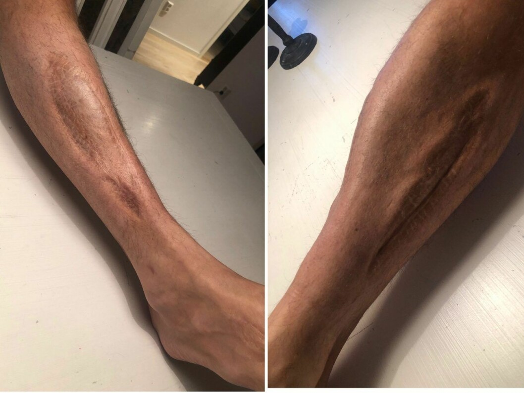 Robbans ärr syns tydligt än idag. Robinson-Robbans ärr på benet syns tydligt.