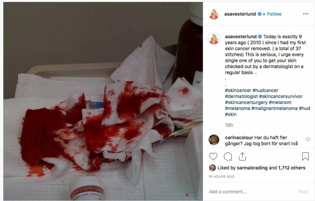 Åsa Vesterlund uppmanar sina följare på Instagram att kolla sina hudförändringar.