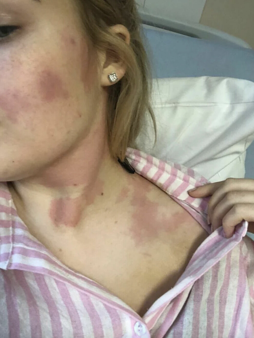 Fick röda utslag längs hela kroppen.