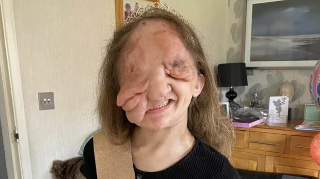 Lizzy Bull, 18, lider av en extremt ovanlig diagnos. Har opererats över hundra gånger sedan födseln.