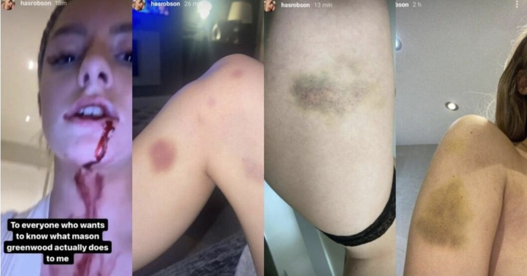 Skärmdumpar från Harriet Robsons Instagram visar blod och blåmärken.
