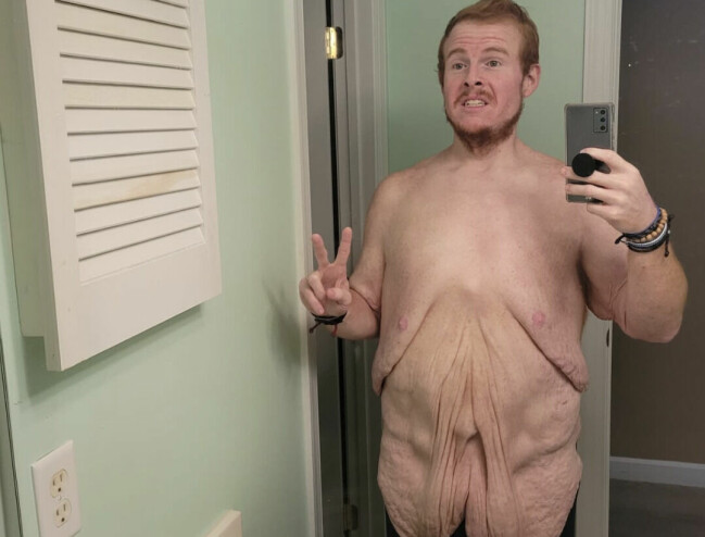 Nu har Casey gått ner över 270 kilo. Casey King efter att ha gått ner i vikt.