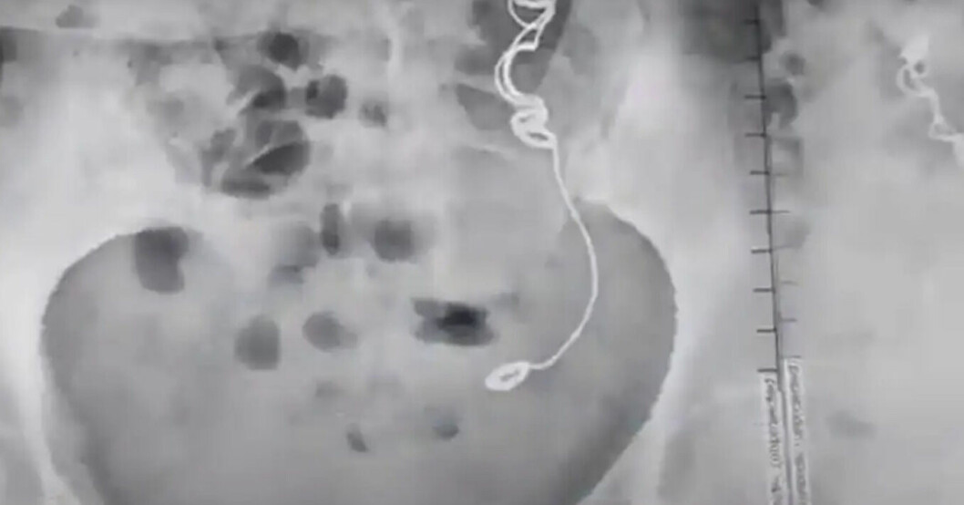 En röntgenbild där en nål och tråd syns.