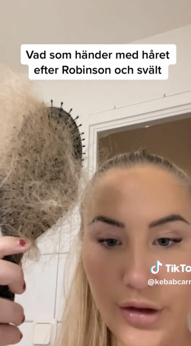 Caroline Persson visar upp hur mycket hår hon tappat