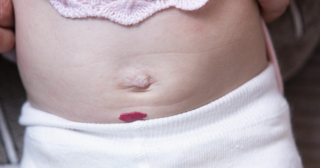 Idag syns det knappt att Millie Woodward föddes med gastroschisis. Millie Woodward