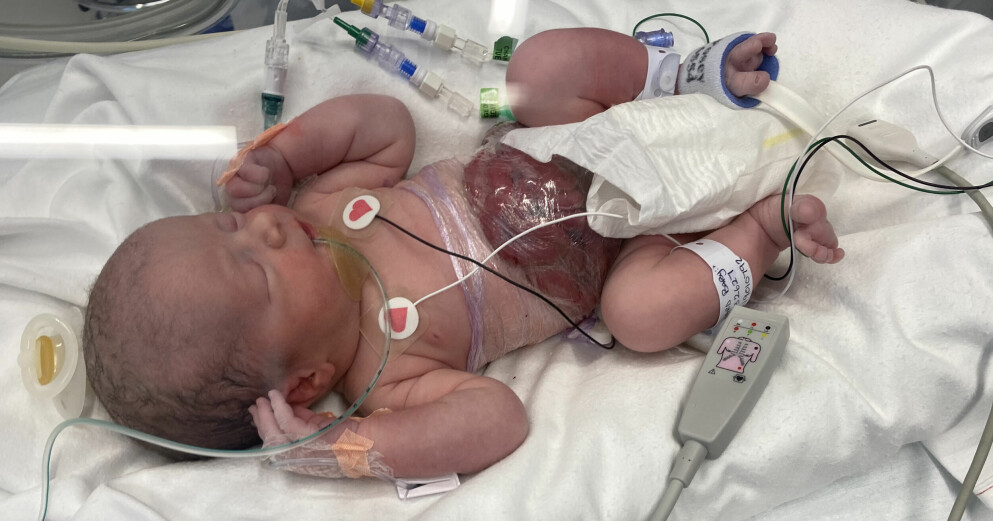 Millie Woodward, 1, föddes med tarmarna utanför kroppen. Ett av 3 000 barn föds med gastroschisis. Millie Woodward